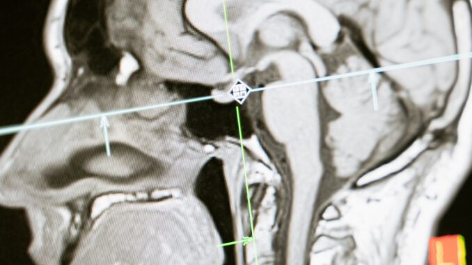 英語　ビジネス　MRI brain